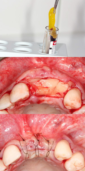 Implant dentar Platelet Rich Fibrin